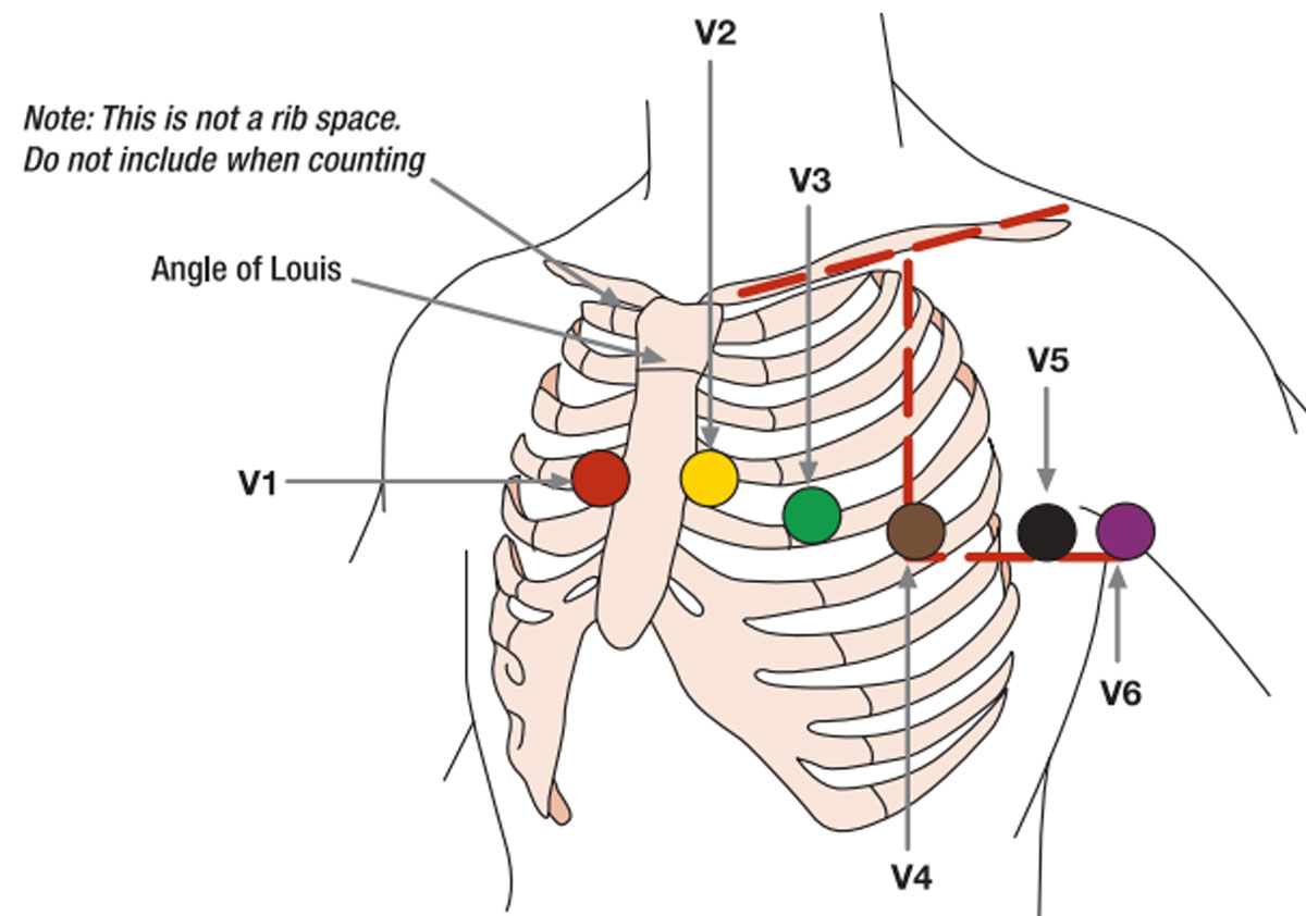 Taking the lead to accurate ECG - Issues and Answers