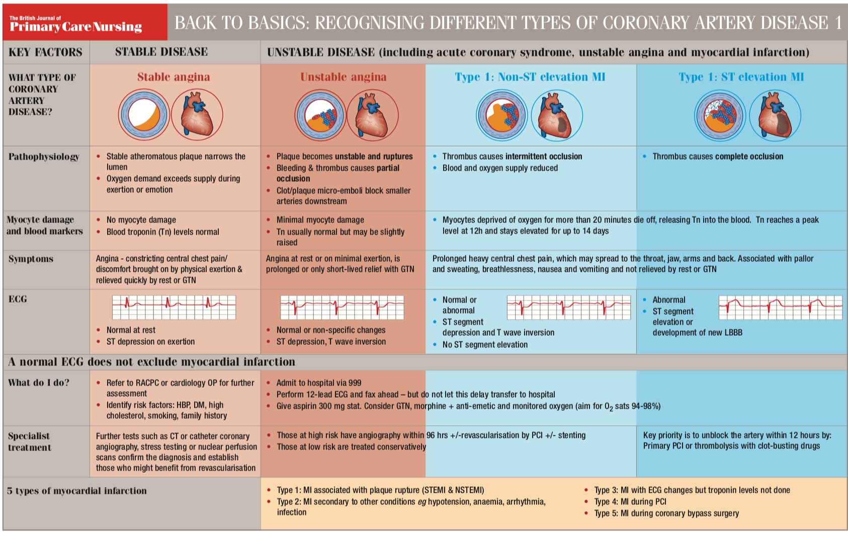 back-to-basics-recognising-different-types-of-coronary-artery-disease